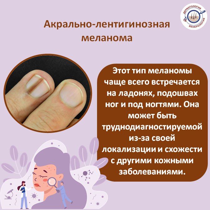 Меланома – это агрессивная форма рака кожи, которая может быстро распространяться и метастазировать Меланома – это агрессивная форма рака кожи, которая может быстро распространяться и метастазировать