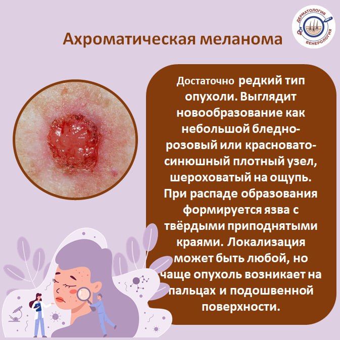 Меланома – это агрессивная форма рака кожи, которая может быстро распространяться и метастазировать Меланома – это агрессивная форма рака кожи, которая может быстро распространяться и метастазировать