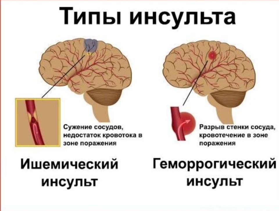 ИНСУЛЬТ: ОПАСНЫЕ СИМПТОМЫ. КОГДА ВЫЗЫВАТЬ СКОРУЮ? КАК ПОМОЧЬ? ИНСУЛЬТ: ОПАСНЫЕ СИМПТОМЫ. КОГДА ВЫЗЫВАТЬ СКОРУЮ? КАК ПОМОЧЬ?