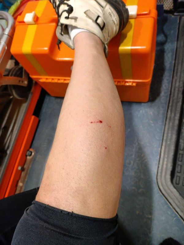 Нападение собак в Луганске: девушка госпитализирована