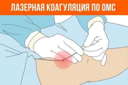 Что такое лазерная коагуляция вен и каковы её преимущества? Какие существуют показания для этой процедуры? Как получить направление на приём?