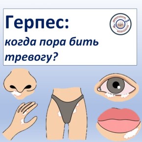 Многие привыкли считать герпес на губах досадной, но безобидной мелочью