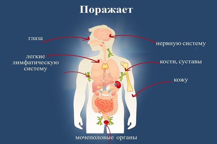Туберкулез поражает не только легкие