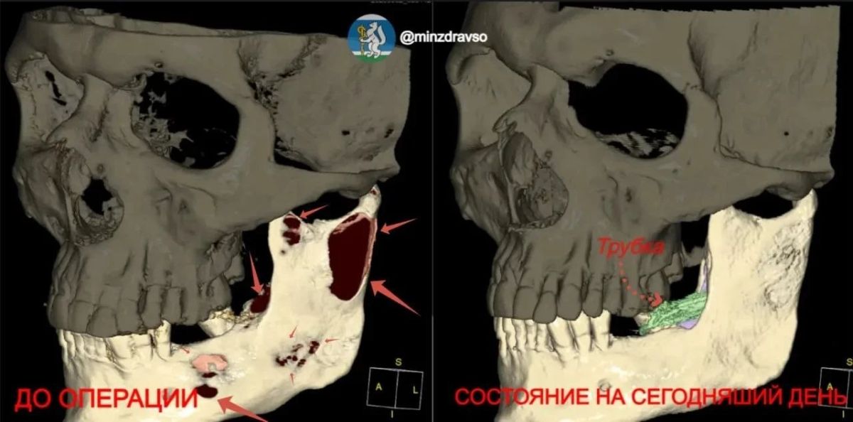 Гигантская киста почти "растворила" челюсть мужчины – костные стенки истончились настолько, что стало сложно открывать рот