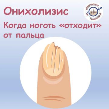 Вы смотрите на свои ногти и замечаете, что у одного из них изменился цвет — он стал желтоватым или беловатым, а под ним будто образовалась пустота? При этом сам ноготь не болит и не беспокоит? Знакомьтесь - онихолизис