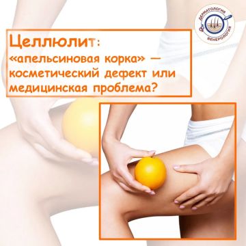 Одни считают целлюлит болезнью, другие — нормой, третьи продают кремы от него